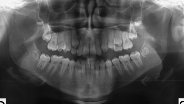 Diagnostica radiologica odontoiatrica in età evolutiva