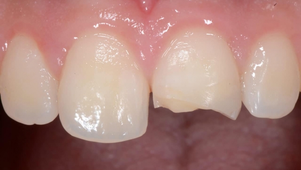 Prevenzione e la gestione clinica dei traumi dentali negli individui in età evolutiva